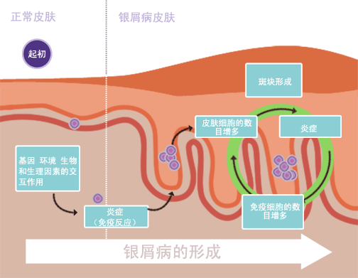 银屑病百科